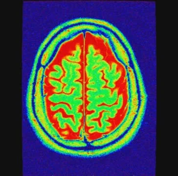 Cranial MRI 스톡 동영상 64799580