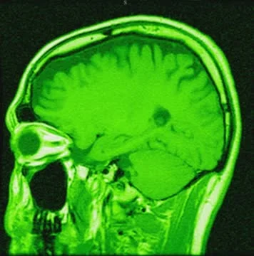 Cranial MRI Vidéo 64799621