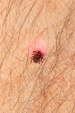 Crawling deer tick on the background of human hairy skin. Infection with Stock Photos