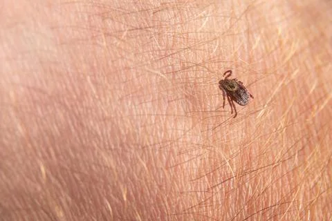 Crawling deer tick on the background of human hairy skin. Infection through the Stock Photos