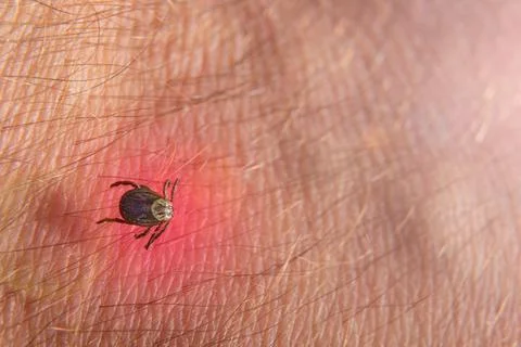 Crawling deer tick on the background of human hairy skin. Stock Photos