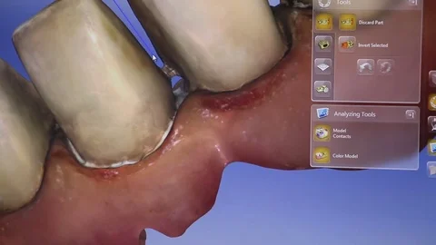 Creating and designing Porcelain Veneer installation Procedure, Dental Veneers 스톡 동영상 80810101