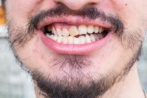 Crooked teeth in a man with a patchy beard Foto stock