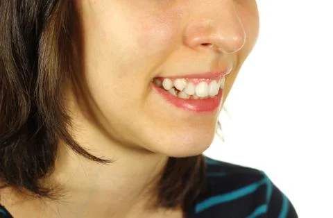 Crooked teeth Stock Photos