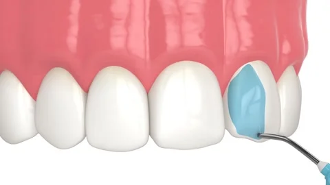 Crooked tooth treatment using bonding procedure with composite resin Video stock 267355530