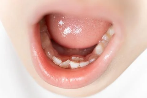 Crookedly growing teeth to replace milk teeth in a child. The second row of Photos