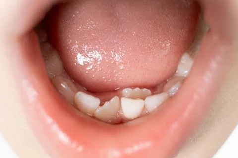 Crookedly growing teeth to replace milk teeth in a child. The second row of.. Foto stock