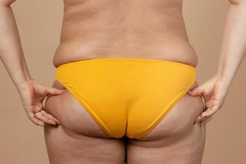 Cropped Image Of Overweight Fat Woman Tummy Losing Weight Excess