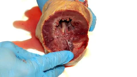 Cross-Section of Human Heart Showing Myocardial Infarction with Blue Gloves Stock Photos