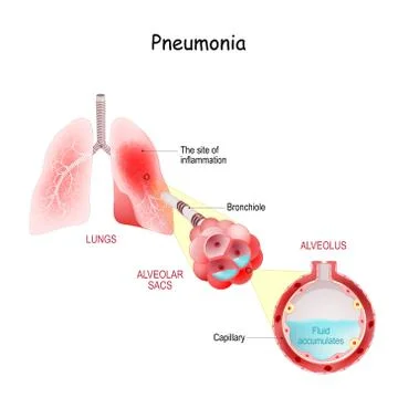 Cross section of Lungs Affected by coronavirus infection. COVID-19 Stock Illustration
