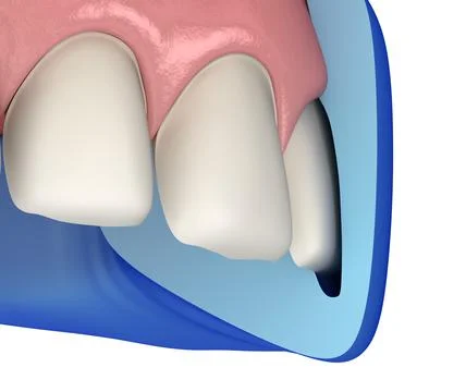 Cross-section of Mock-up dental key and prepareted incisor. Stock Illustration