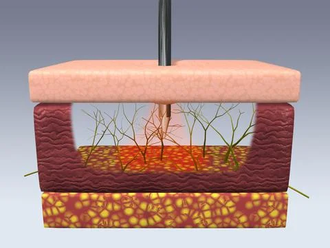 Cross section of skin nerve cells feeling pain of a pin prick イラスト素材