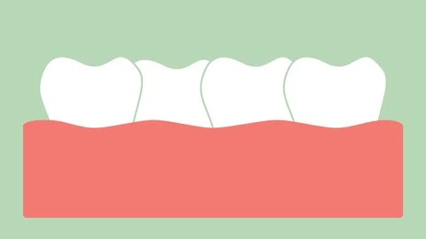 Crowding teeth ( malocclusion ) Stock Footage 105335614