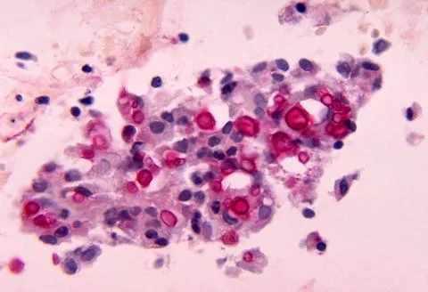  Cryptococcosis This micrograph depicts the histopathologic changes associ... Stock Photos