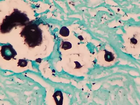 Cryptococcus neoformans in lung tissue - Warthin Starry silver stain Stock Photos