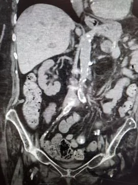 CT Abdomen - constipation, with stool in colon Stock Photos