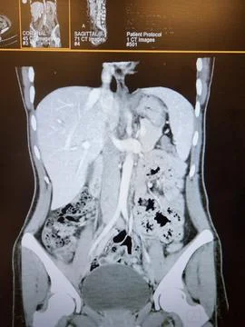CT Abdomen - constipation, with stool in colon Stock Photos