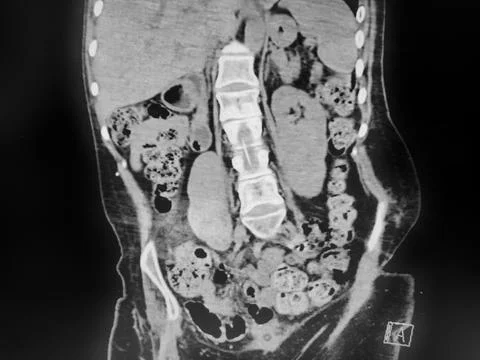 CT Abdomen - constipation, with stool in colon Stock Photos