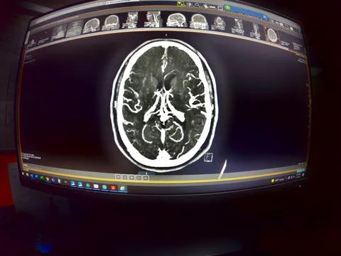 CT Brain angiography image on computer monitor Stock Photos