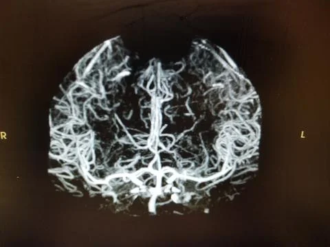 CT Brain angiography image on computer monitor Stock Photos