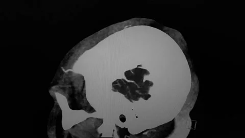 CT Brain angiography - sagittal image in black, white Stock Footage 231616940