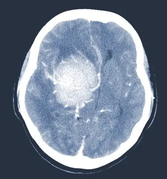 CT Brain Axial scans hyperdense mass with homogeneous, and mild perilesiona.. Stock Photos