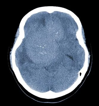 CT Brain Axial scans hyperdense mass with homogeneous, and mild perilesiona.. Stock Photos