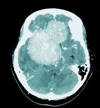 CT Brain Axial scans hyperdense mass with homogeneous, and mild perilesiona.. Stock Photos