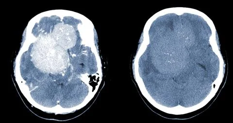 CT Brain Axial scans hyperdense mass with homogeneous, and mild perilesiona.. Stock Photos