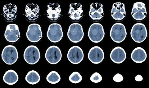 CT Brain Axial scans hyperdense mass with homogeneous, and mild perilesiona.. Stock Photos