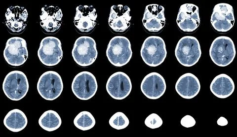 CT Brain Axial scans hyperdense mass with homogeneous, and mild perilesiona.. Stock Photos