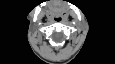 CT brain C7 fracture Stock Footage 132535629