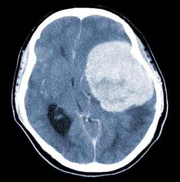 CT Brain History Headache Finding a 7 cm. extra-axial mass with stong enhance Stock Photos