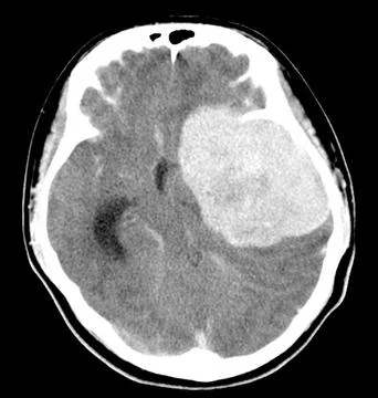 CT Brain History Headache Finding a 7 cm. extra-axial mass with stong enhance Stock Photos