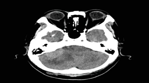 CT brain malignant neoplasm of brain 4K Stock Footage 132490138