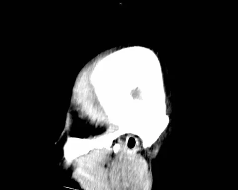 CT Brain NC Brain tumor male 45Y Stock Footage 132375626