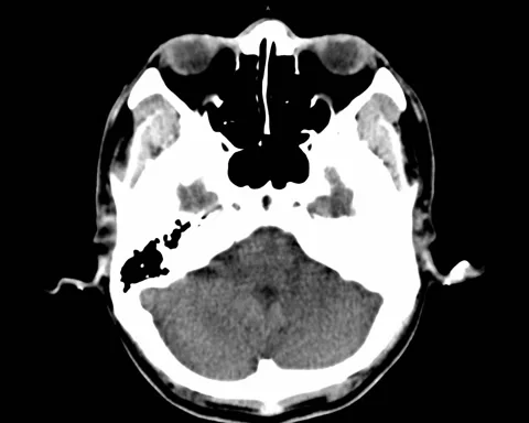 CT Brain NC Brain tumor male 45Y Stock Footage 132375628