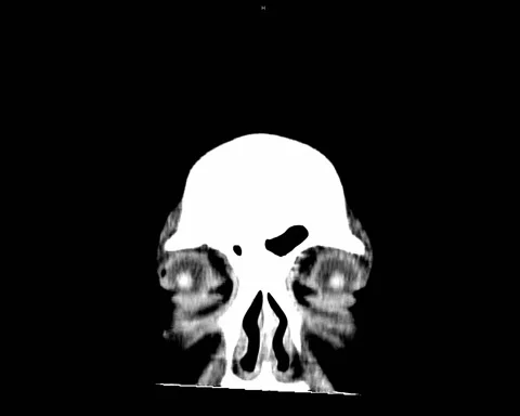 CT Brain NC Brain tumor male 45Y Stock Footage 132375638