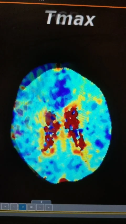 CT Brain perfusion images as colorized HD Movie Stock Footage 170010991