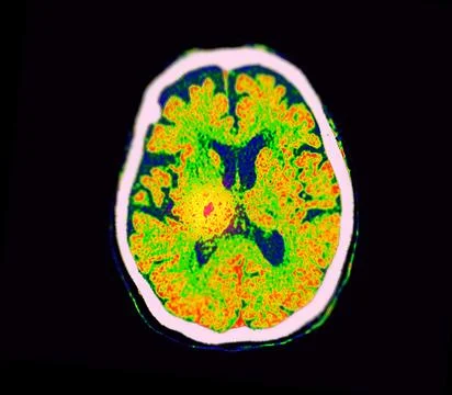CT Brain Perfusion or CT scan image of the brain axial view  showing  cereb.. Stock Illustration