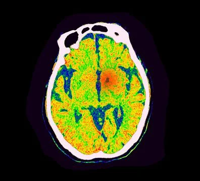 CT Brain Perfusion or CT scan image of the brain axial view  showing  cereb.. Illustrazione stock