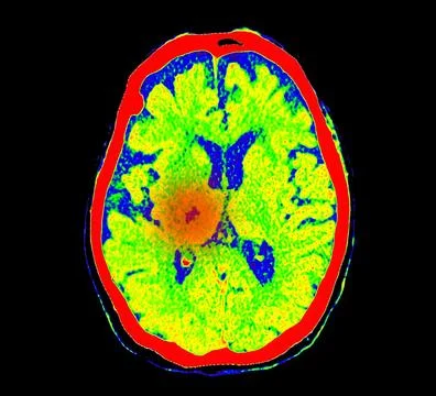 CT Brain Perfusion or CT scan image of the brain axial view  showing  cereb.. Stock Illustration