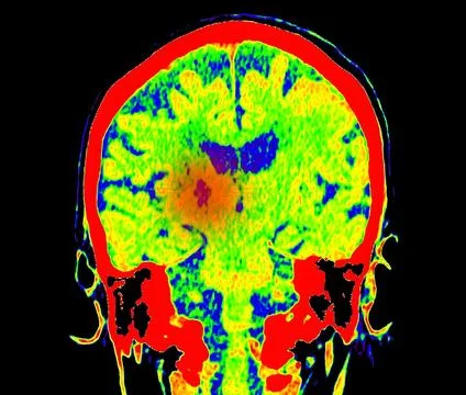 CT Brain Perfusion or CT scan image of the brain axial view  showing  cereb.. Stock-Illustration