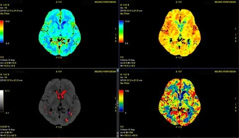 CT Brain Perfusion or CT scan image of the brain 3d rendering image analysing Stock Photos