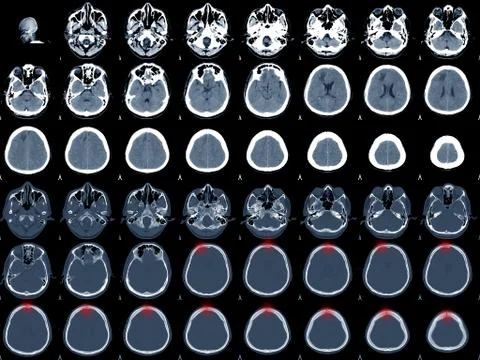 CT-Brain Stock Photos
