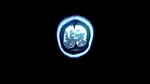 CT Brain scan image MRI human anatomy disease research healthy adult male 库存影片 336569227