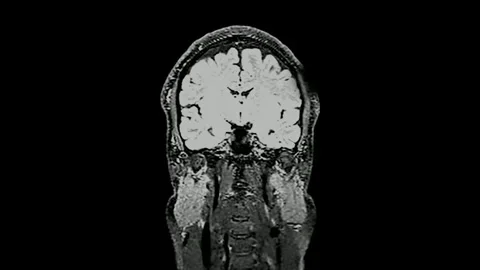 CT Brain scan image MRI human anatomy disease research healthy adult male 스톡 동영상 336569273