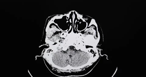 A CT brain scan of a patient with car accident and intracerebral hemorrhage Stock Footage 159704732