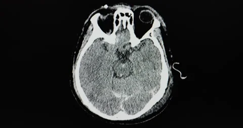 CT brian showing contusion rt occipital ... | Stock Video | Pond5