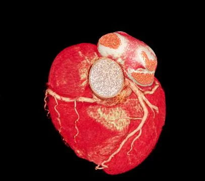 CT Cardiac 3D or CTA coronary artery Stock Illustration